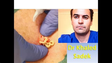 Cheesy Cyst Dr Khaled Sadek LipomaCyst Com YouTube