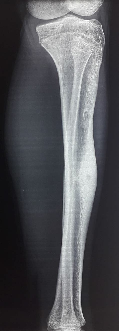 Osteoid Osteoma Tibia Image