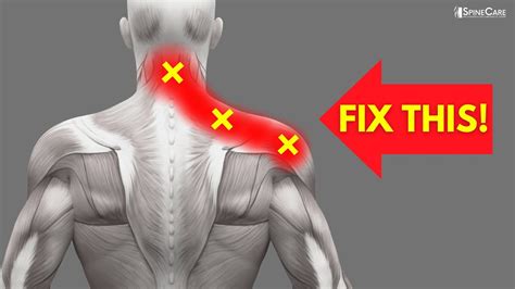 How To Instantly Fix Pinched Nerve Pain In The Neck And Shoulders Youtube