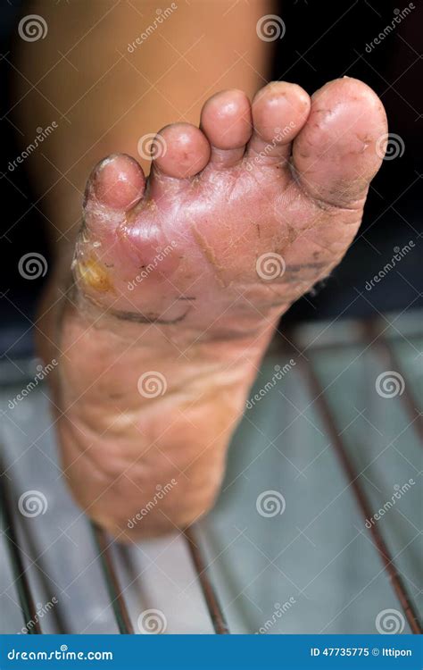 Wound Of Diabetic Foot Stock Image Image Of Distress 47735775