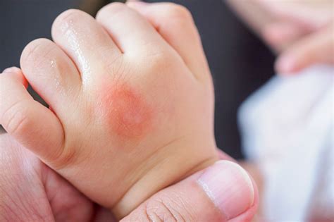 모기에 물린에 의해 붉은 자리 원인 알레르기 피부 발진과 아기 손 건강관리와 의술에 대한 스톡 사진 및 기타 이미지 Istock