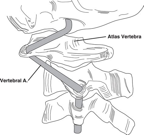 Cervical Artery Dissection A Comparison Of Highly Dynamic Mechanisms
