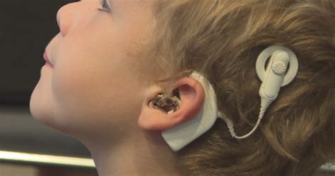 Coalition Demands ‘life Changing Cochlear Implant Surgery In Montreal