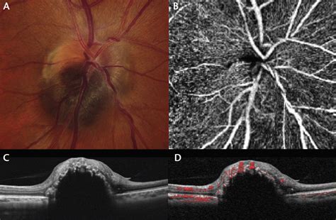 Optic Disc Melanocytoma Imaging With Octa Retina Today