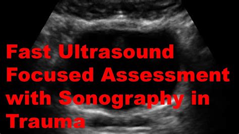 Fast Ultrasound Focused Assessment With Sonography In Trauma Youtube