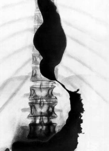 Диета при ахалазии пищевода кардии Ахалазия кардии | это... Что такое Ахалазия кардии? Ахалазия кардии | это... Что такое Ахалазия кардии? Диета при ахалазии пищевода кардии