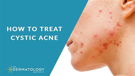 How To Treat Cystic Acne Pimple Popping Videos