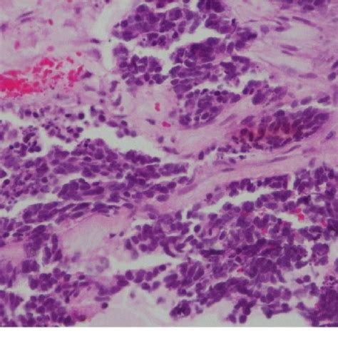 Sections From The Lung Biopsy Show A Small Cell Carcinoma Composed Of