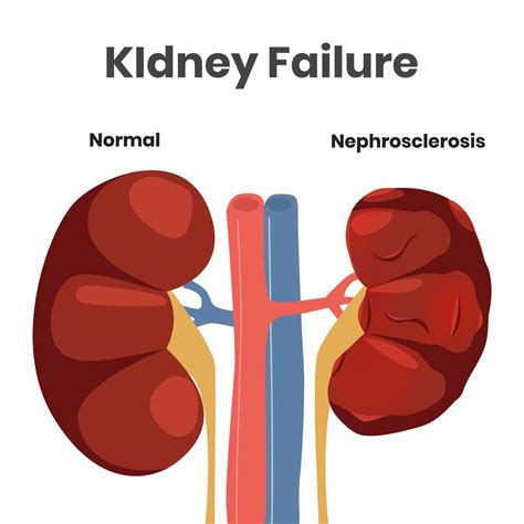 Is Renal Failure Kidney Disease