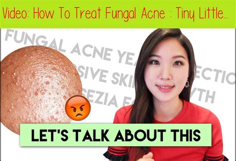 How To Treat Fungal Acne Tiny Little Bumps On The Forehead Acne