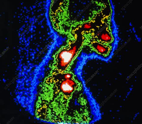 Gamma Camera Scan Of Skull Stock Image M1340051 Science Photo