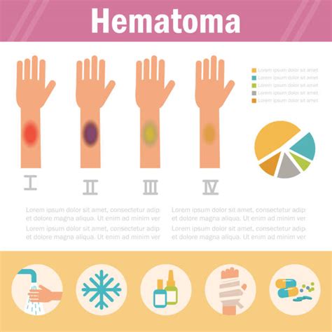 Hematoma Illustrations Royalty Free Vector Graphics And Clip Art Istock