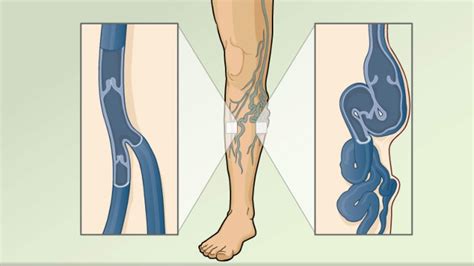 Hie Multimedia Varicose Veins What To Ask Your Doctor