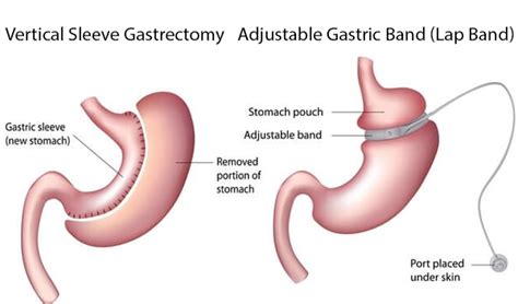 Sleeve Gastrectomy Vs Gastric Bypass