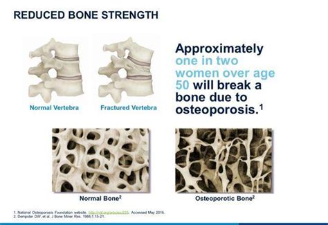 Osteoporosis And Vertebral Compression Fracture Brian K Rich Md