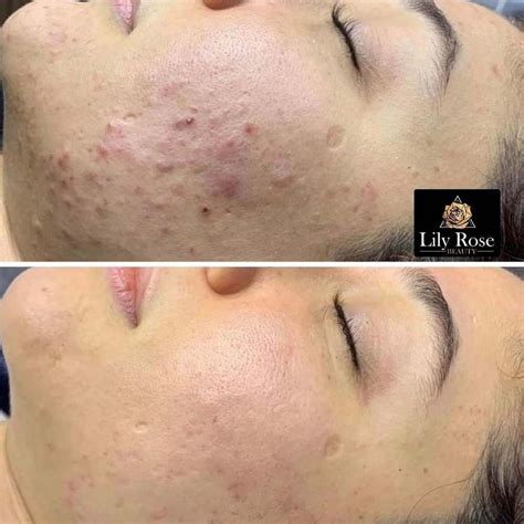 Microneedling Before And After Gallery Best Transformations