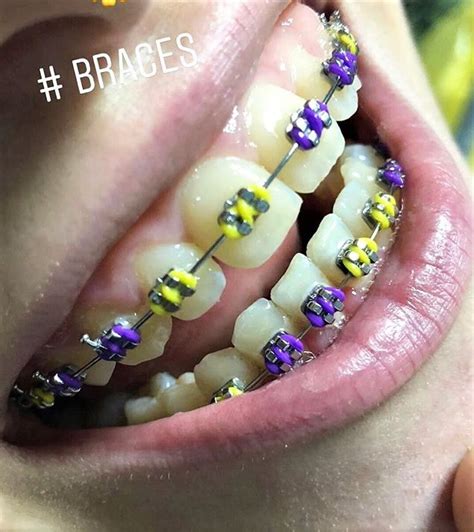 Pin By John Beeson On Orthodontic Braces Braces Colors Coloring For