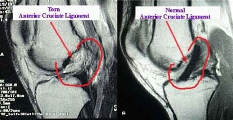 In this case, the acl is completely blown apart. MRI wonders - The MagpieStory - ACL Tear and Recovery
