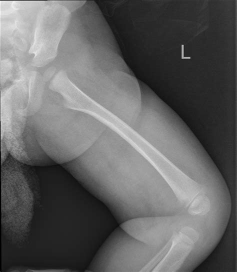 Distal Femoral Osteomyelitis And Subperiosteal Abscess Image