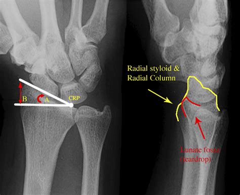 Radial Styloid Fractures Journal Of Hand Surgery