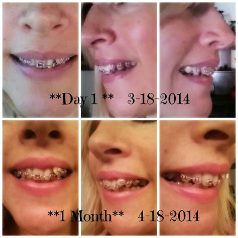 Adult Braces My Journey 1st Month Experience With Braces