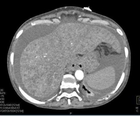 Liver Cirrhosis Ct Scan