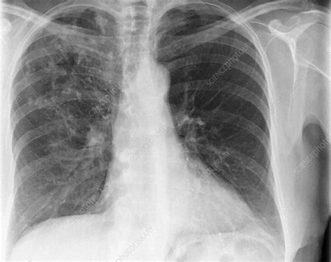 Tuberculosis Scarring X Ray Stock Image C0517779 Science Photo