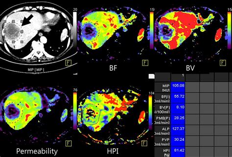 Ct Perfusion Of The Liver Principles And Applications In Oncology