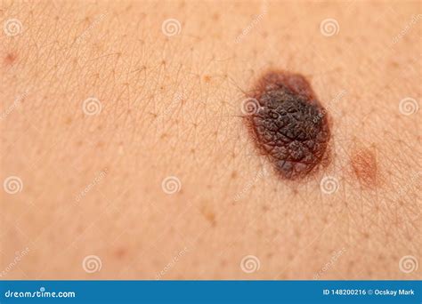 Dangerous Nevus On Skin Melanoma Stock Photo Image Of Benign
