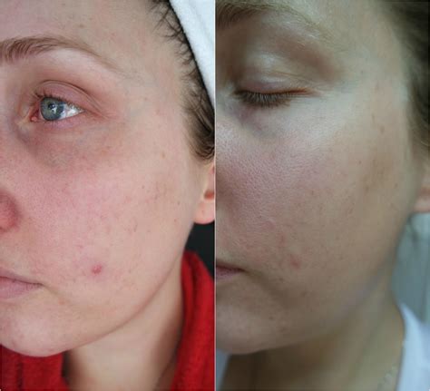 Franish: my experience with microneedling