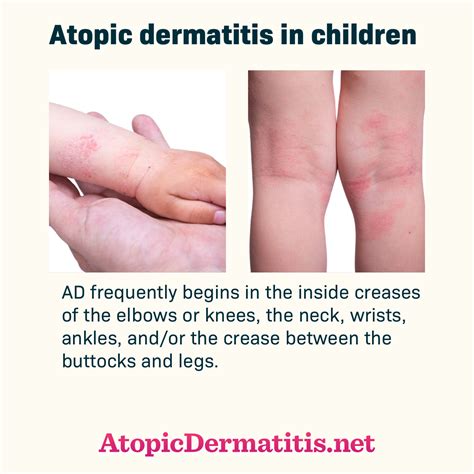 What Is Atopic Dermatitis Or Atopic Eczema