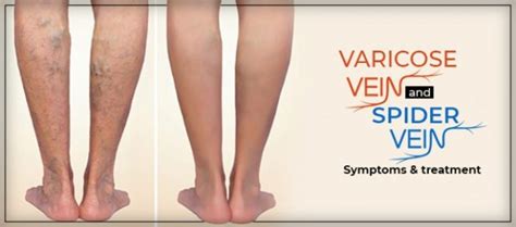 Varicose Veins And Spider Veins Symptoms And Treatment