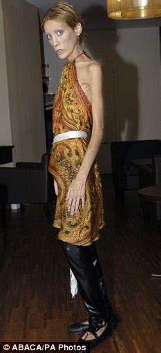 Anorexic Model Who Appeared In Shock Fashion Campaign Dies At 28 Dechive