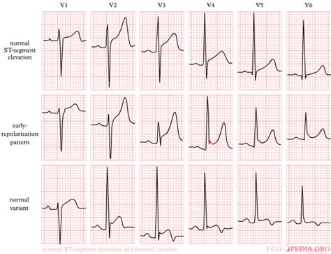 St Elevation Myocardial Infarction Electrocardiogram Wikidoc