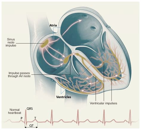 Heart Rhythm Problems Disorders Causes Symptoms And Treatment