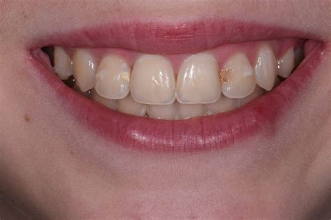 Exposed Cavities Between Front Teeth Aacd Cosmetic Dentist Auckland