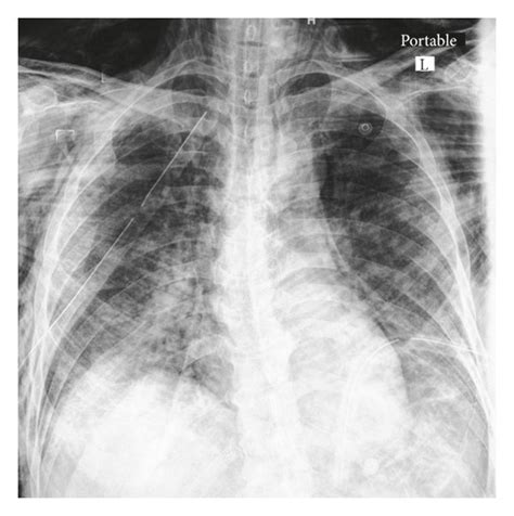 Chest X Rays Showing Pneumomediastinum And Subcutaneous Emphysema The