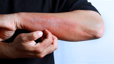 Eczema Tipos Causas Sintomas E Tratamento Médico Saudedia