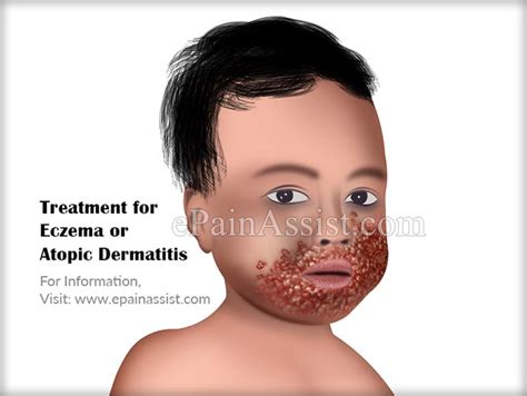 Atopic Dermatitis Face Treatment Doctor Heck