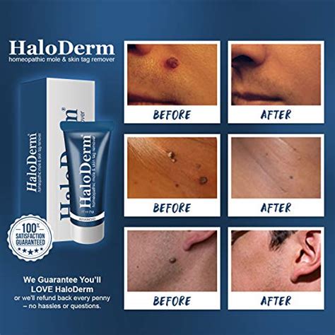 haloderm advanced mole and skin tag remover removes 5 moles or skin tags fast results in as