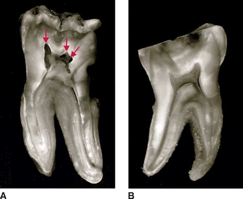 Internal Pulp Cavity Morphology Related To Endodontic And Restorative