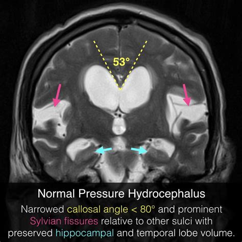 Normal Pressure Hydrocephalus Radiopaedia Org