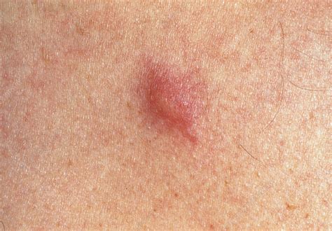 View Of A Mosquito Bite On A Patients Skin Stock Image M3200263