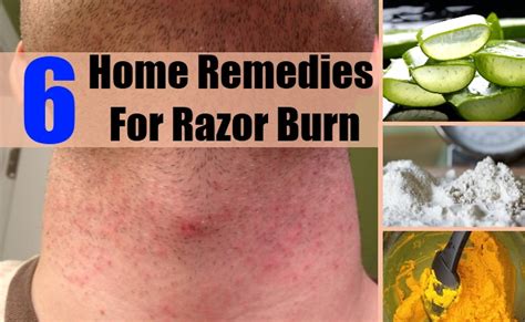 Top 6 Home Remedies For Razor Burn Natural Home Remedies And Supplements