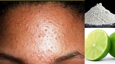 How To Get Rid Of Forehead Acne Causes And Prevention Tips Artofit
