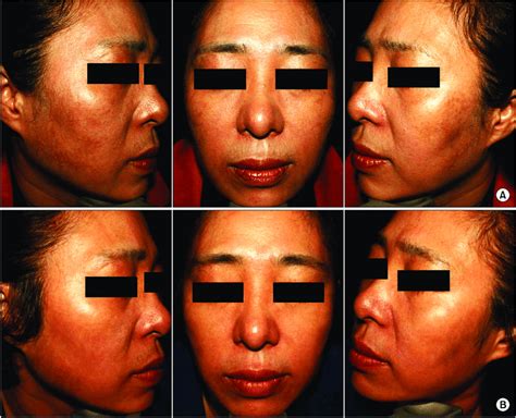 Representative Photographs Of A 56 Year Old Female Patient With Melasma