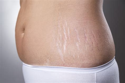 Are Lasers The Best Treatment For Removing Stretch Marks
