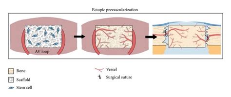 Vascularization Approaches For Bone Tissue Engineering A In Vitro