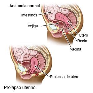 Prolapso Uterino Care Guide Information En Espanol