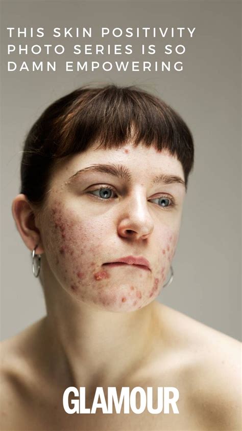 This Skin Positivity Photo Series Is So Damn Empowering Artofit